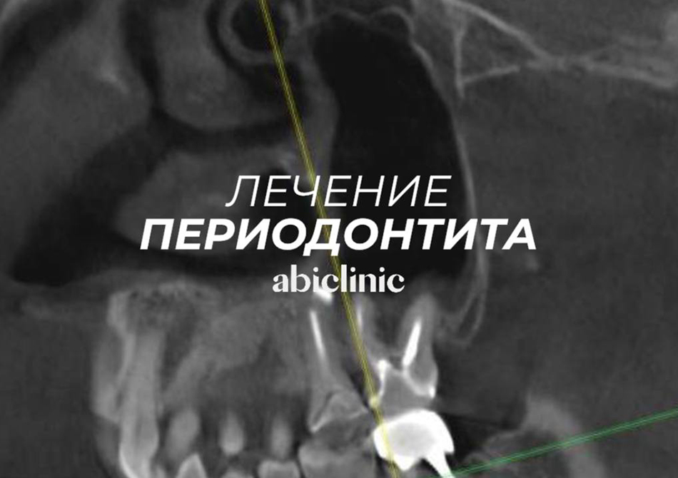 Лечение периодонтита