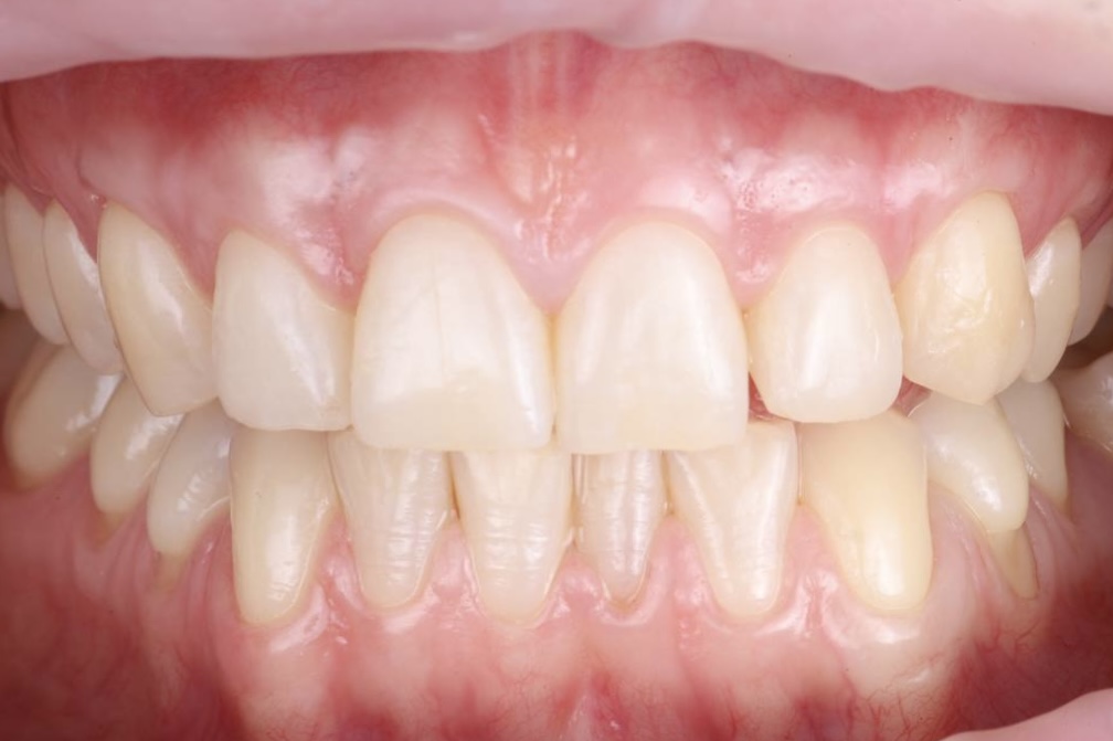 После лечения