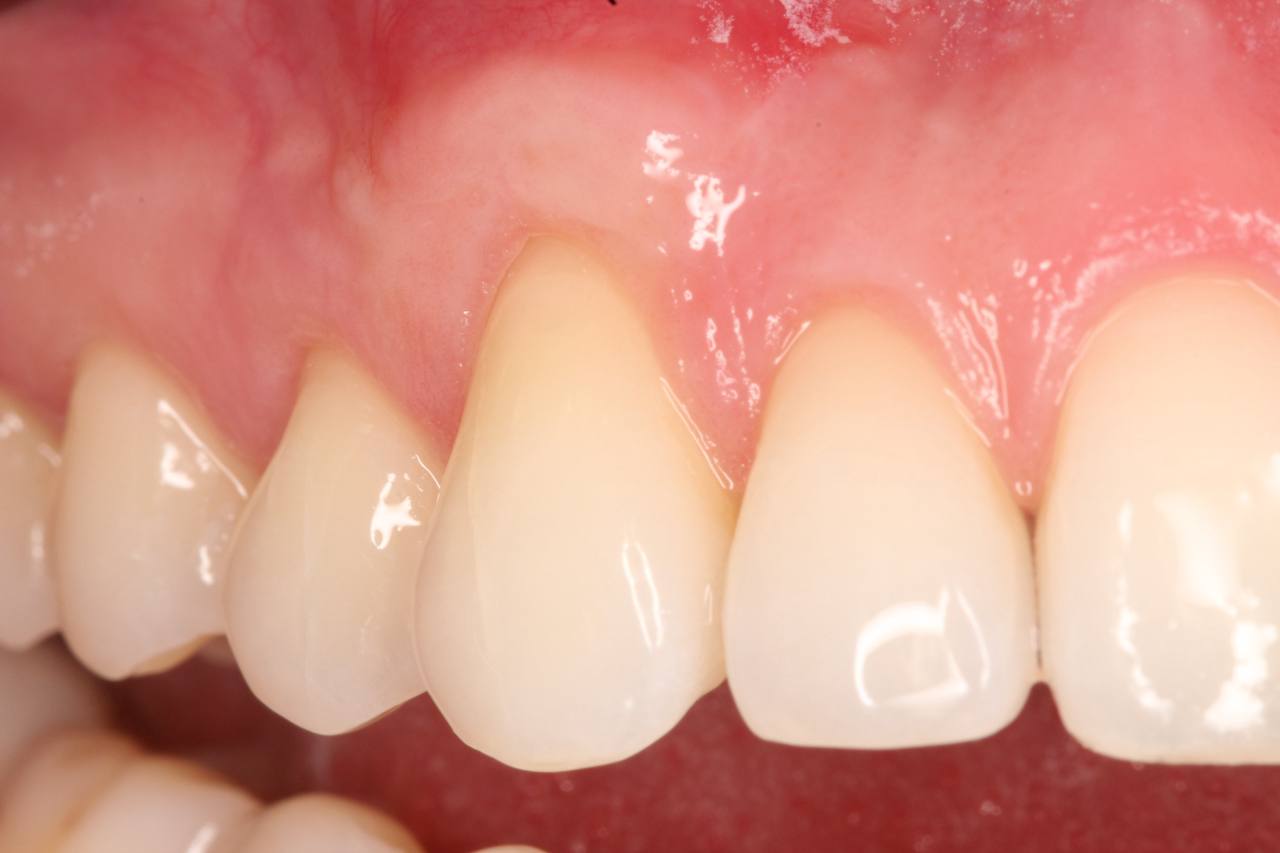 После лечения