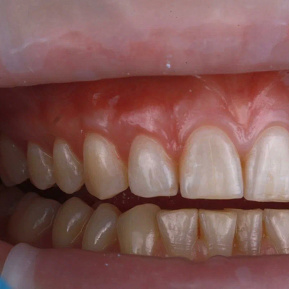 После лечения