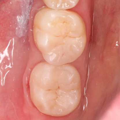 После лечения